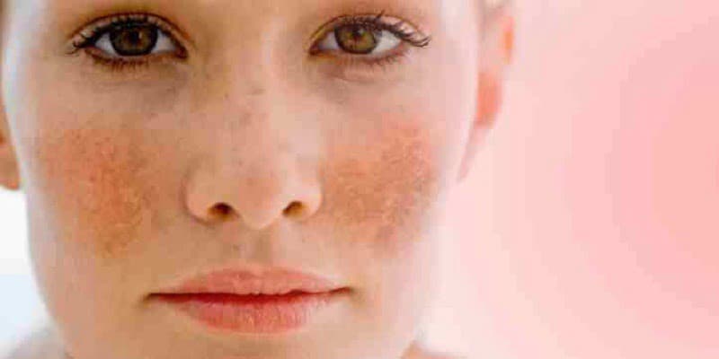 Melasma and Ayurveda
