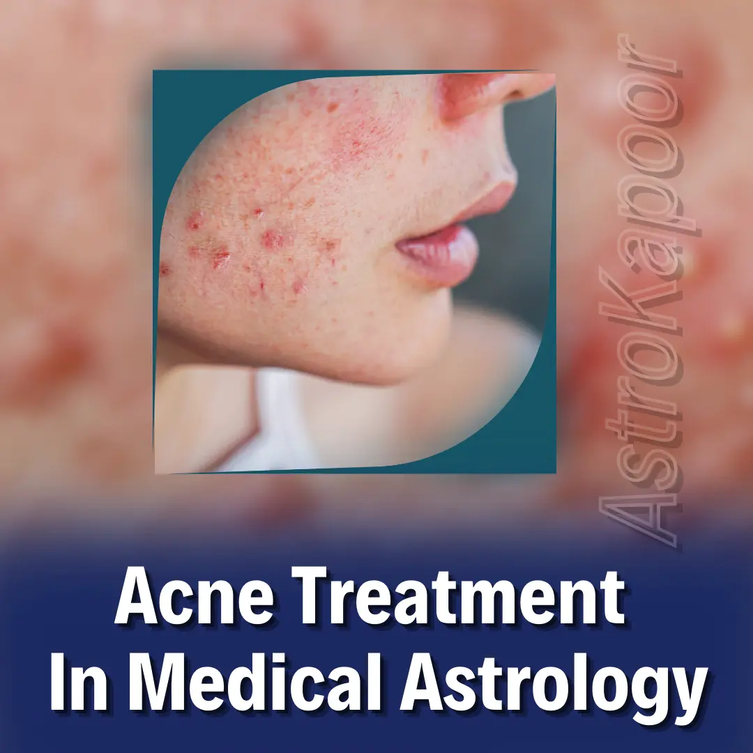 Acne Treatment In Medical Astrology Image
