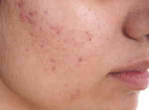 Acne Treatment in Medical Astrology