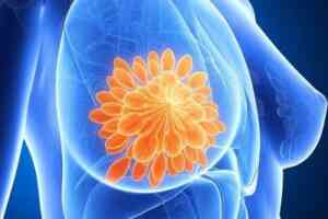 Breast Cancer Treatment in Medical Astrology