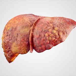 Cirrhosis of Liver Treatment in Medical Astrology