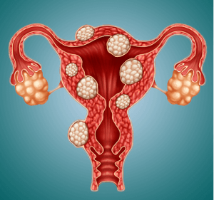 Fibroids Treatment in Medical Astrology