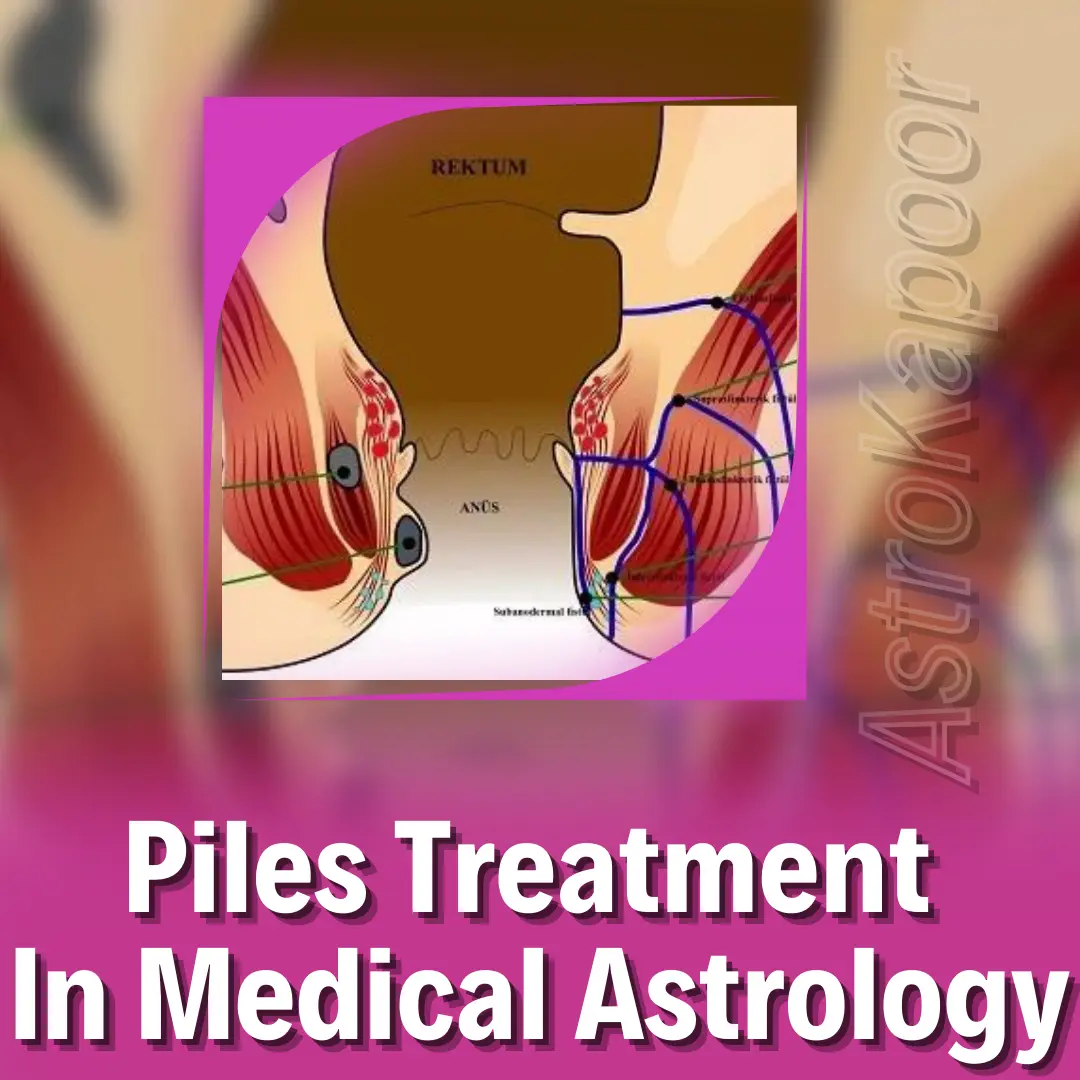 Piles Treatment In Medical Astrology Image