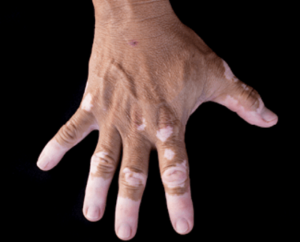 Skin Disease Treatment In Medical Astrology
