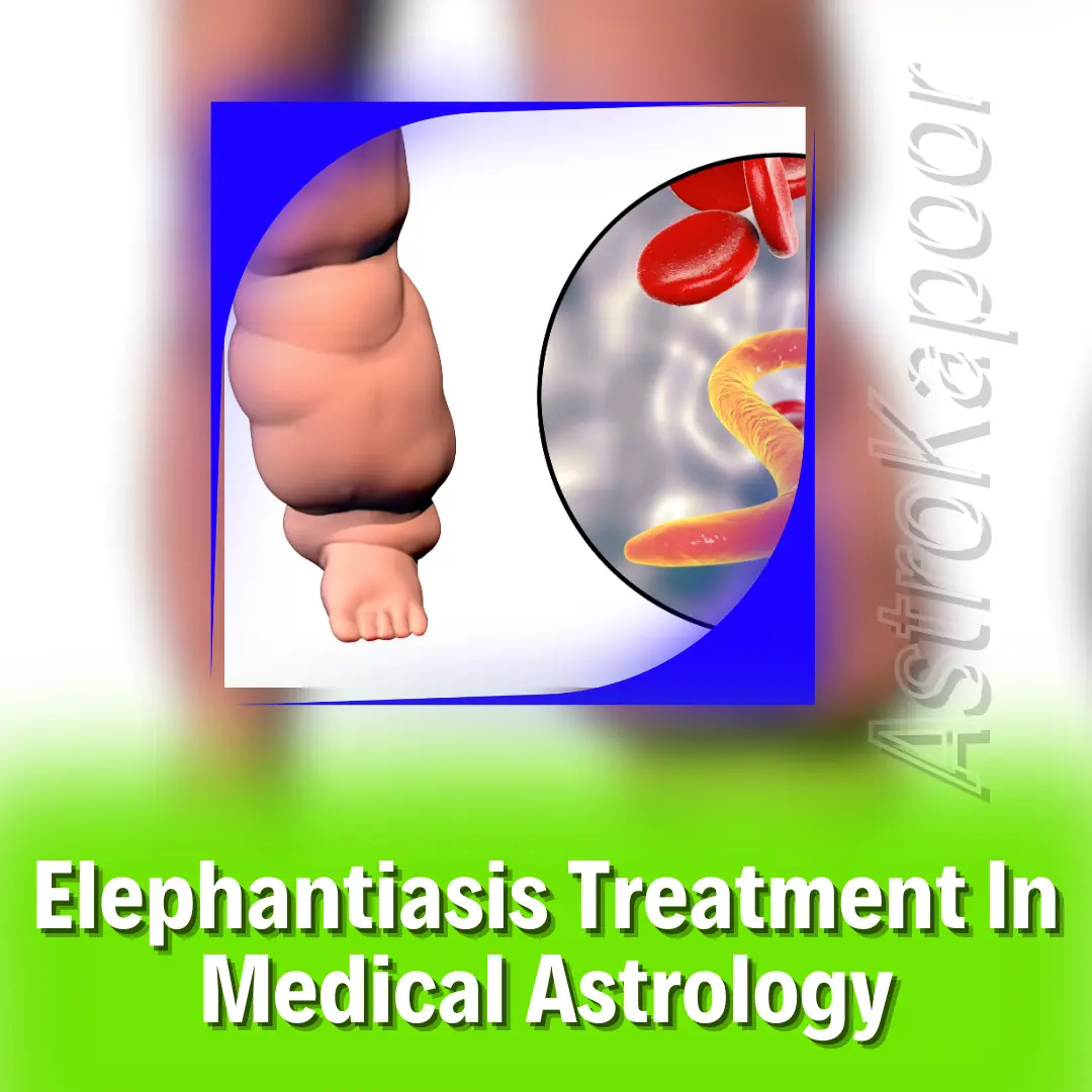 Elephantiasis Treatment In Medical Astrology Image