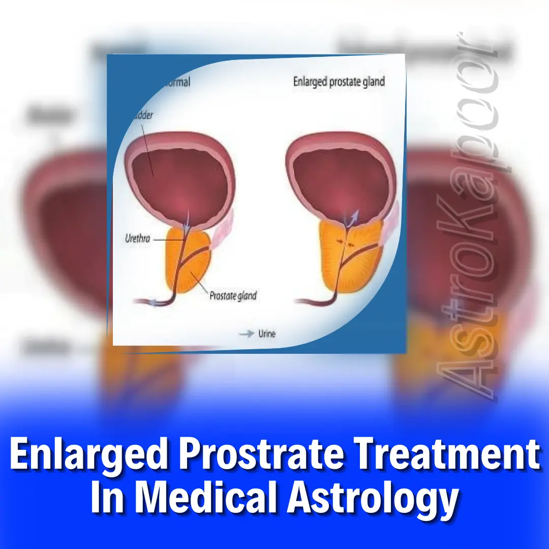 Enlarged Prostrate Treatment In Medical Astrology Image