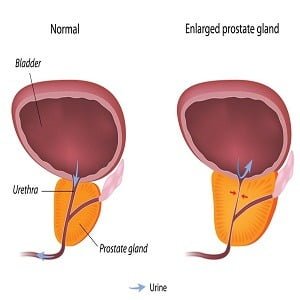 Enlarged Prostrate Treatment in Medical Astrology
