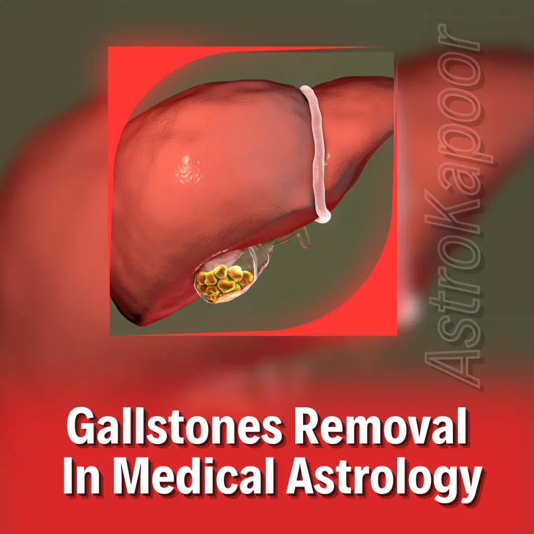 Gallstones Removal In Medical Astrology Image
