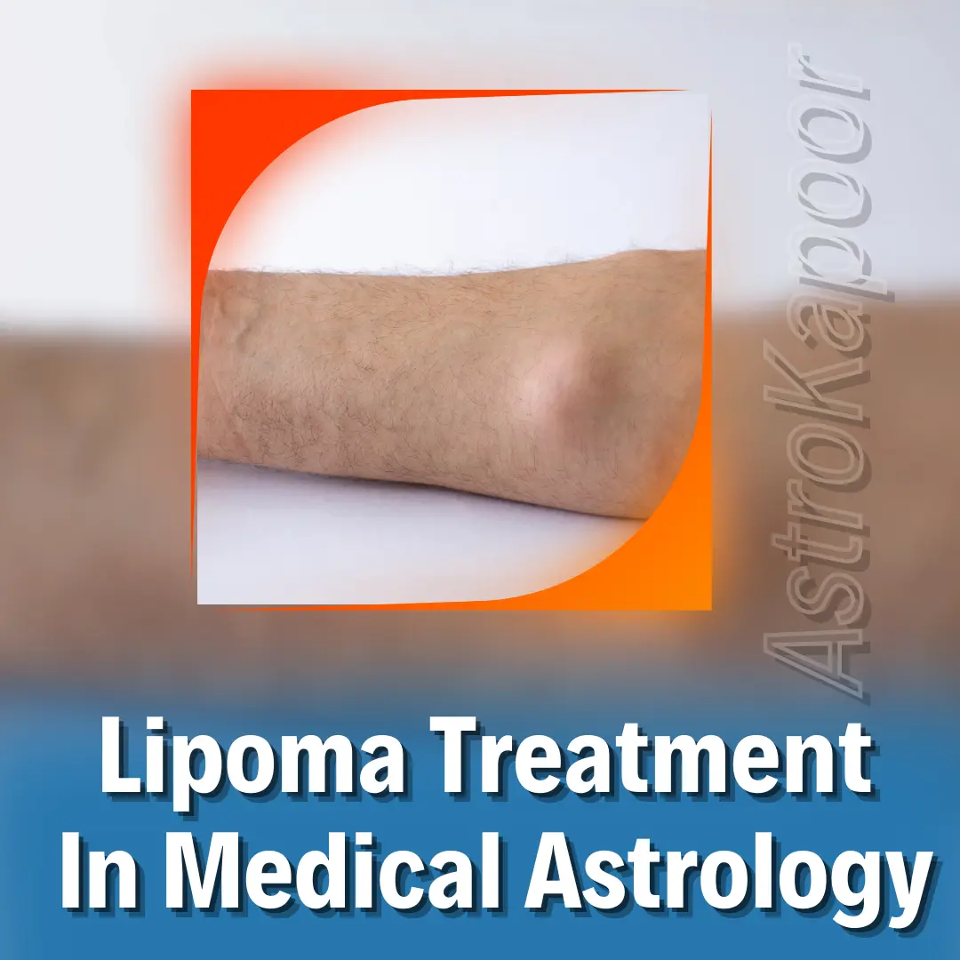 Lipoma Treatment In Medical Astrology Image