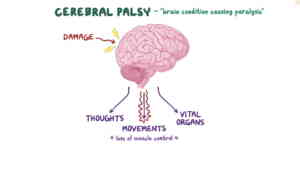 Cerebral palsy treatment in Medical astrology