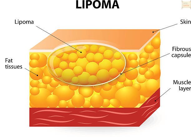 Lipoma Treatment in Medical Astrology