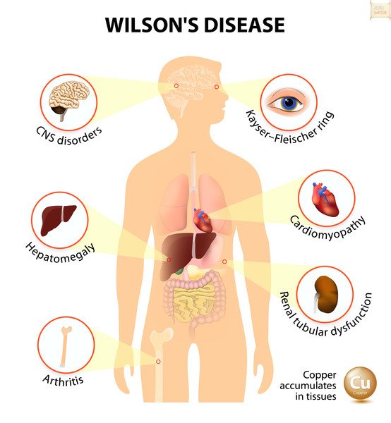 Wilson disease treatment in medical astrology