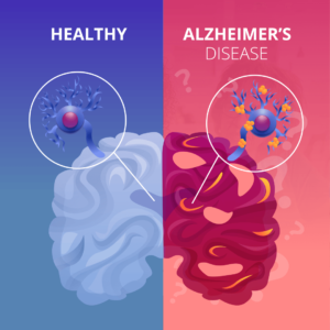 Alzheimers-Treatment-in-Medical-Astrology