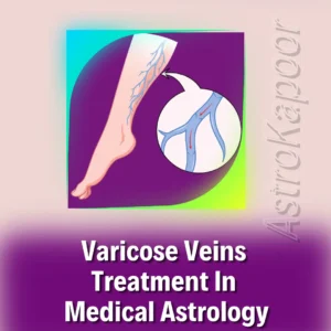 Varicose Veins Treatment In Medical Astrology Image