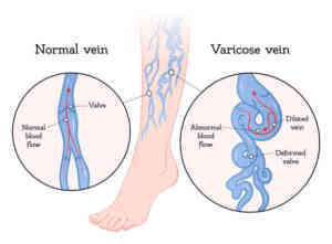 Varicose Veins treatment in medical astrology