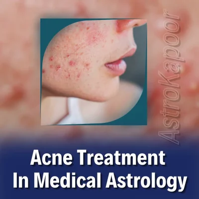 Acne Treatment In Medical Astrology Image