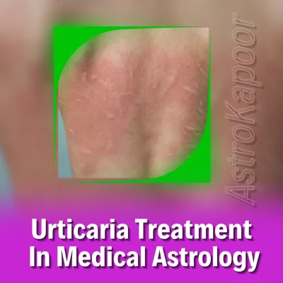 Urticaria Treatment In Medical Astrology Image